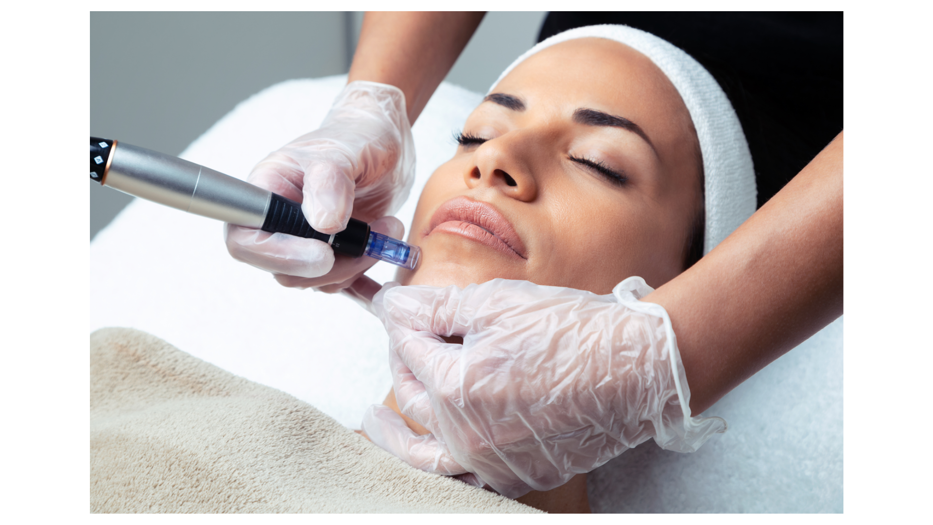 microneedling